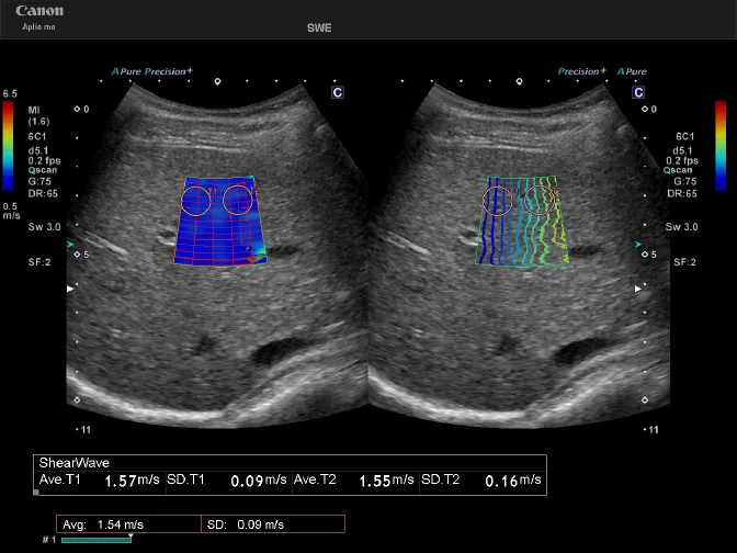 SWE（肝硬度測定画像）