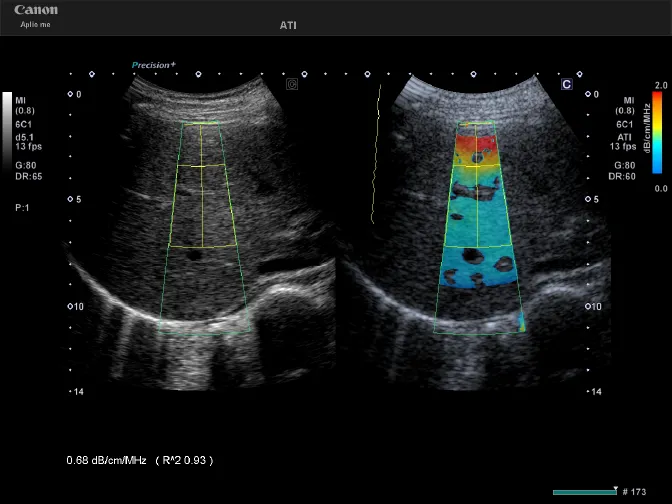 ATI（脂肪化測定画像）